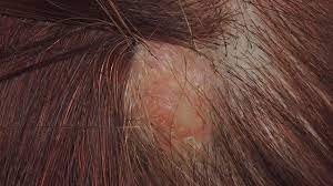ingrown hair cyst symptoms treatment