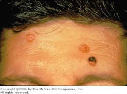 Image result for cryptococcosis