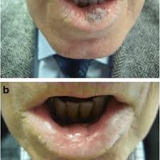 vl of the lower lip extending