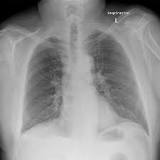 Chest radiograph | Radiology Reference Article | Radiopaedia.org