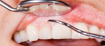 Buatlah pemeriksaan gigi di klinik gigi setahun sekali atau dua kali. Update Harga Biaya Terbaru Cuci Gigi Scaling Di Puskesmas Klinik Dan Rumah Sakit Daftar Harga Tarif