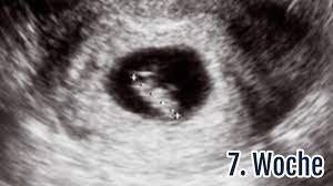 Ssw (16 4) es ist sogar ein kurzes stück mit 3d ultraschall dabei! 7 Ssw Die 7 Schwangerschaftswoche Anzeichen Ultraschall Tipps Netmoms De