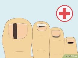 how to treat a black toenail causes
