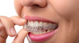 Let's take a closer look at how to straighten teeth without braces using mouth guards. Guide To Tooth Alignment For Adults College Of Dentistry University Of Illinois At Chicago