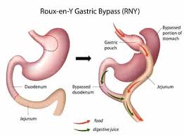 gastric byp surgery dr shieh