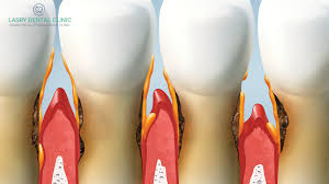 gum graft surgery cost procedure and