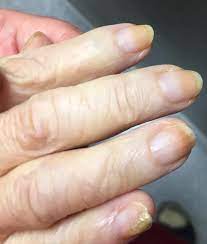 transverse orange nail lesions