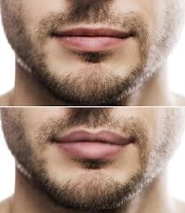 result of lip augmentation male lips