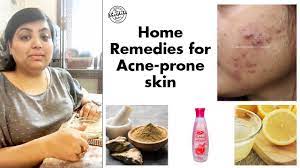 home remedy for oily acne e skin