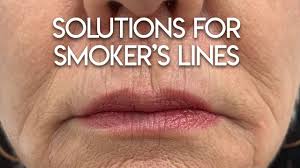 solutions for smoker s lines you