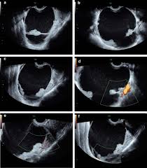 Sensitivity and specificity of multimodal and ultrasound. Ovarian Borderline Tumor Presenting As Ovarian Torsion In A 17 Year Old Patient A Case Report Journal Of Medical Case Reports Full Text