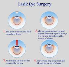 lasik surgery in punjab lasik surgery