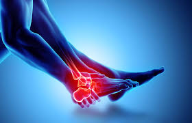 sprained ankles types causes