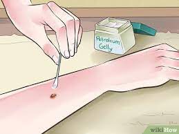 how to heal from a skin biopsy with