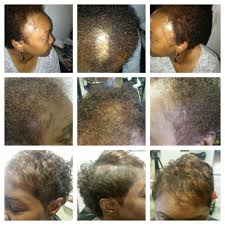 This is also why laser hair therapy, is such a powerful tool at fighting hair loss. Low Level Laser Therapy Lllt New Image Hair Studio