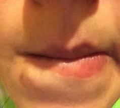 a lip piercing scar tissue