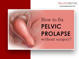 fix pelvic prolapse without surgery