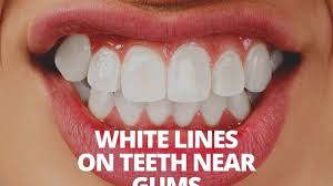white lines on teeth near gums