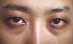 remove dark circles around eyes