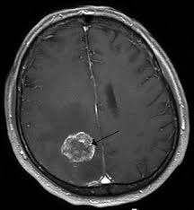 Brain Tumor Wikipedia