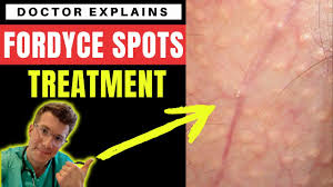 how to treat fordyce spots doctor o