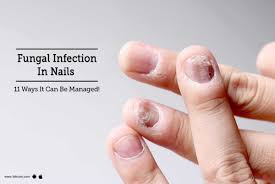fungal infection in nails 11 ways it