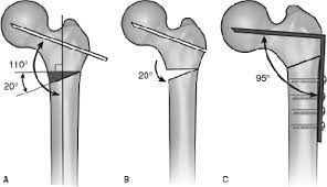 fem head osteonecrosis proximal