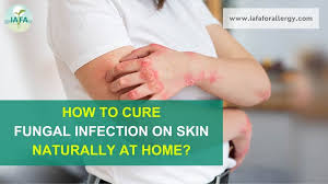 cure fungal infection on skin naturally