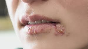 Blister on lip: What are the different types and how are they treated?