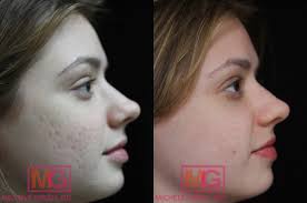 tca cross acne scars procedure