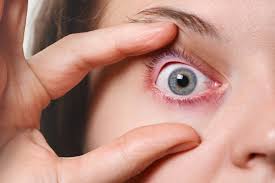 get rid of a chalazion