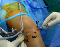 al meniscus extrusion reduction