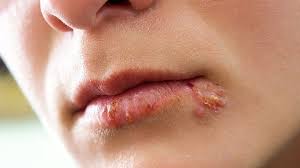 how to hide a cold sore skin and