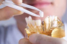 dental implants cost in canada