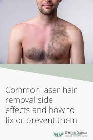 common laser hair removal side effects