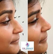 non surgical rhinoplasy london nose