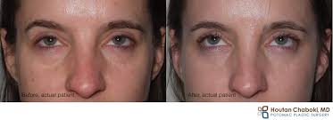 puffy lower eyelids are not always from fat