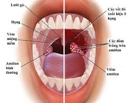 sore throat with swollen glands