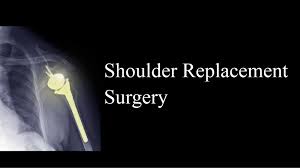 shoulder replacement surgery corpus