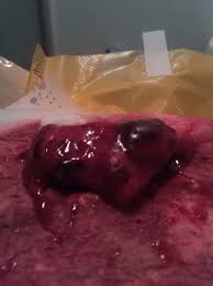 The decidual cast is when the entire lining passes spontaneously. Endometrial Cast Tmi With Pic Babycenter