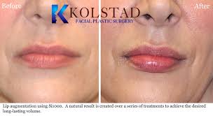 permanent lip augmentation san go