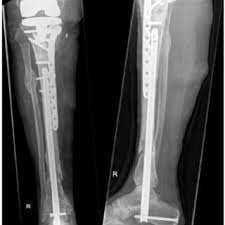 t2 ankle arthrodesis nail
