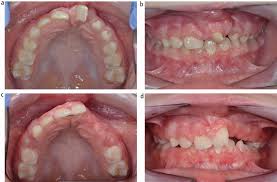 cleft lip and palate