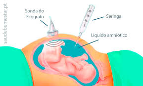 amniocentese o que é indicações do