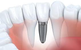 root c vs implant which is best
