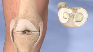 torn meniscus uw orthopaedic surgery