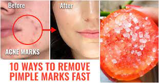 8 ways to remove pimple marks naturally
