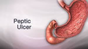 peptic ulcer information mount sinai