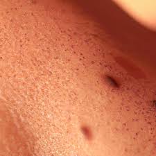 moles freckles skin s lentigines
