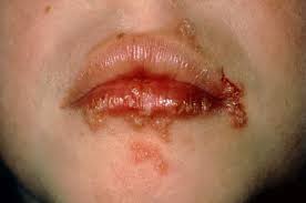cold sores and herpes